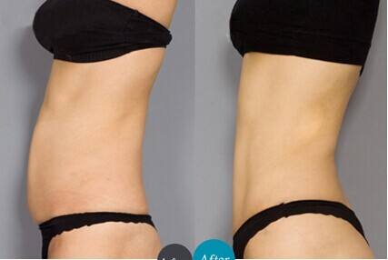 腹部吸脂手術(shù)后注意什么?