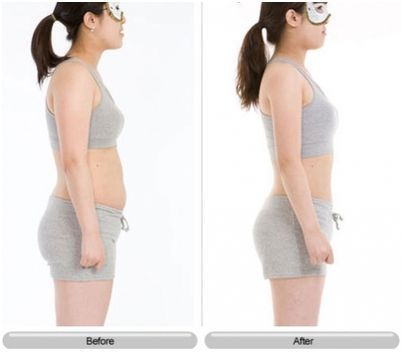 腹部吸脂手術(shù)后注意什么?