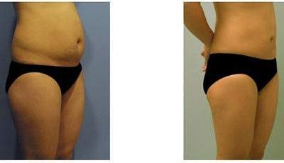 腹部吸脂術影響身體健康嗎？