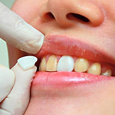 烤瓷牙價格是多少?