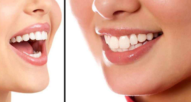 烤瓷牙價格是多少?