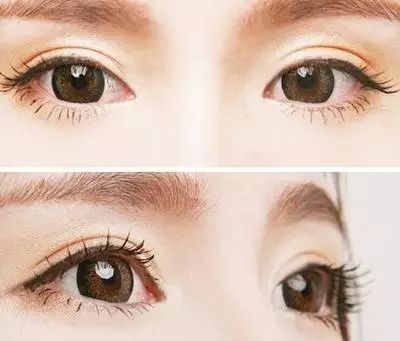 雙眼皮埋線多少錢?