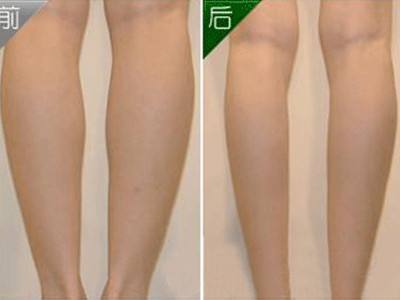 吸脂減肥手術(shù)要注意什么?