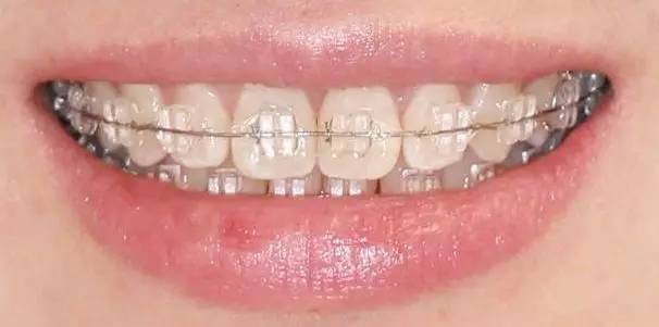 牙齒矯正價格貴嗎?