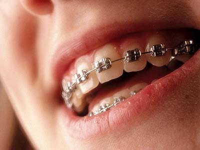 牙齒矯正價格貴嗎?