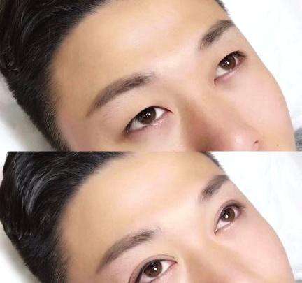 眼皮抽脂多少錢?