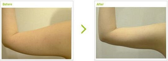 抽脂價格是多少?