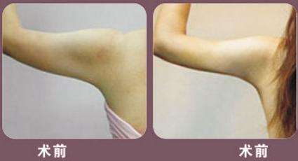 抽脂價格是多少?