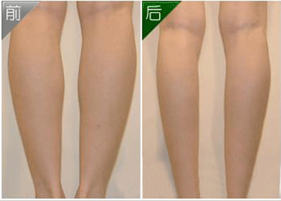 抽脂瘦腿多少錢？