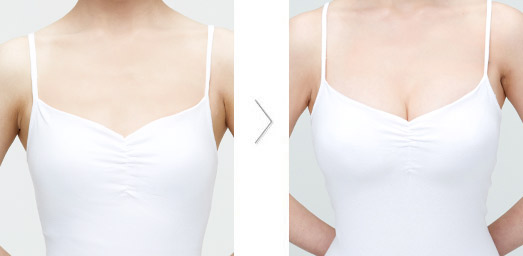 乳房再造手術有什么需要注意的?