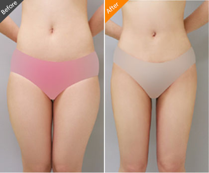 腿部抽脂會反彈嗎？