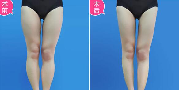 吸脂價(jià)格是多少?