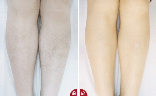 小腿激光脫毛后怎么護理？