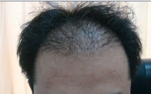 植發的術后護理要注意什么?