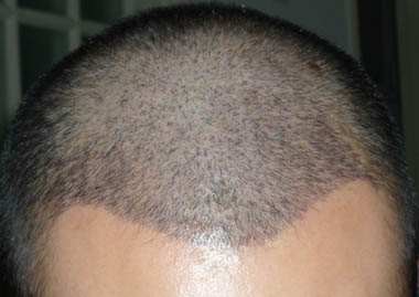 植發效果怎么樣?