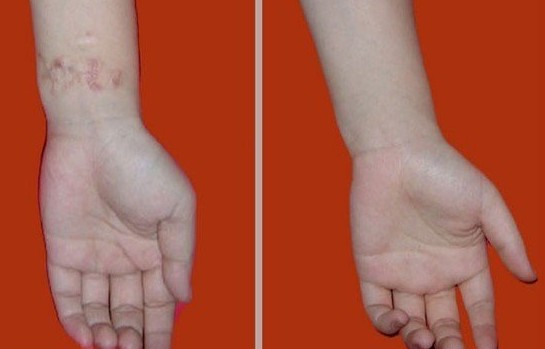 燒傷疤痕修復要注意什么？