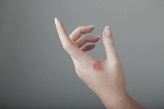 燒傷疤痕修復要注意什么？