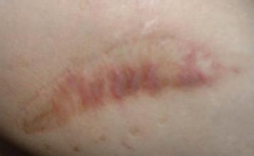 燒傷疤痕修復要注意什么？