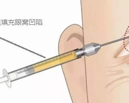 新年集福,怎可讓“眼窩凹陷”影響運(yùn)氣?