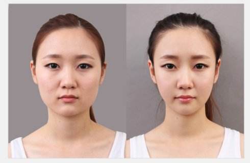 瘦臉的瘦臉效果好不好？