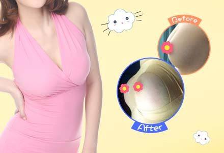 自體脂肪隆胸有什么要注意的?