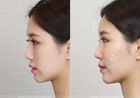 玻尿酸打蘋果肌怎么樣?