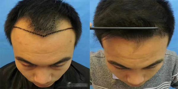 頭發(fā)種植后怎么護理？