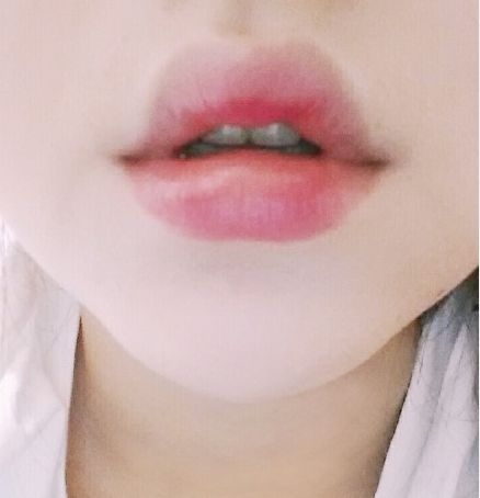 用玻尿酸豐唇后怎么護理？