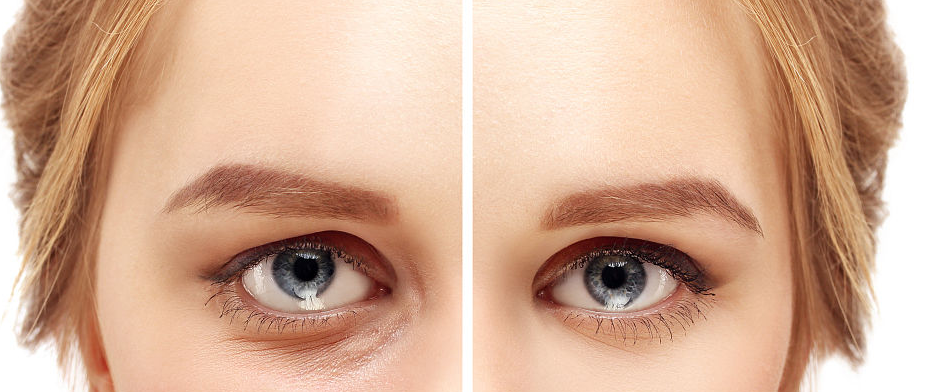 手術去眼袋要多久能恢復?