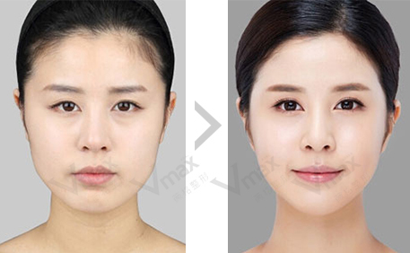 昆明開眼角要多久恢復?有什么注意事項?