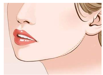 成都下頜角整形手術(shù)需要多少錢？