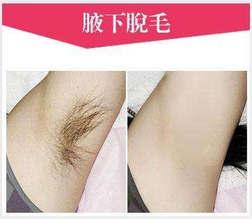 美萊冰點脫毛效果怎么樣?