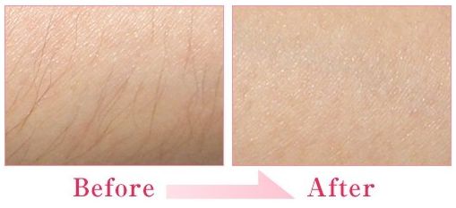 美萊冰點脫毛效果怎么樣?