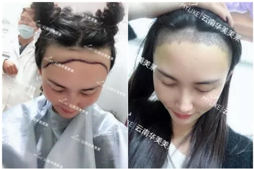 科技，讓植發更簡單丨美萊ARTAS機器人植發優勢