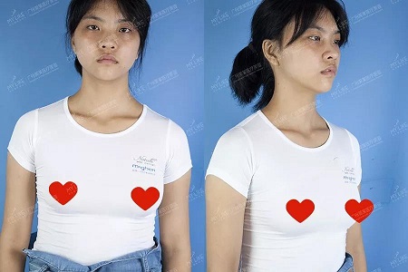 what?34C罩杯的細腿精,抽了200ml脂肪隆胸!