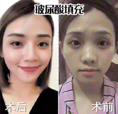 面對(duì)法令紋，玻尿酸or脂肪填充誰(shuí)才是救命大佬？