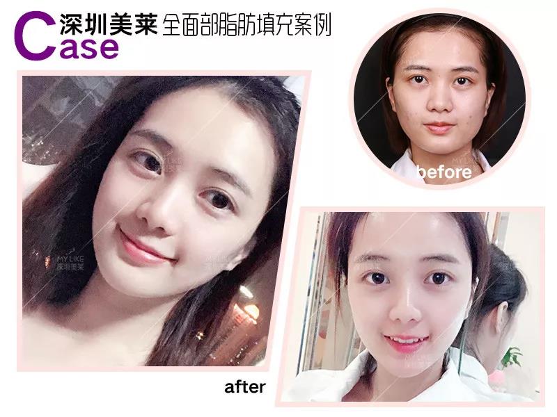 對比玻尿酸起脂肪填充更危險，為什么醫師還要推薦它？