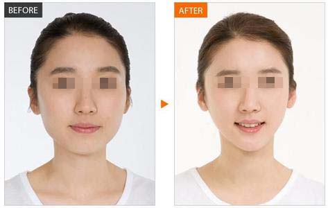 天津注射瘦臉針的效果能不能維持一年?