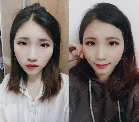 <a href='/ybzx/syp/' target='_blank'><u>割雙眼皮</u></a>5天,土妞變潮妹!