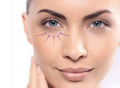 祛眼袋手術什么年齡段做比較好？