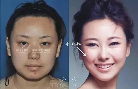 這四種臉型打玻尿酸+瘦臉,立刻變專業小V臉