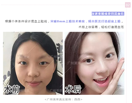 腫眼泡?重內眥?