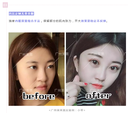 腫眼泡?重內眥?