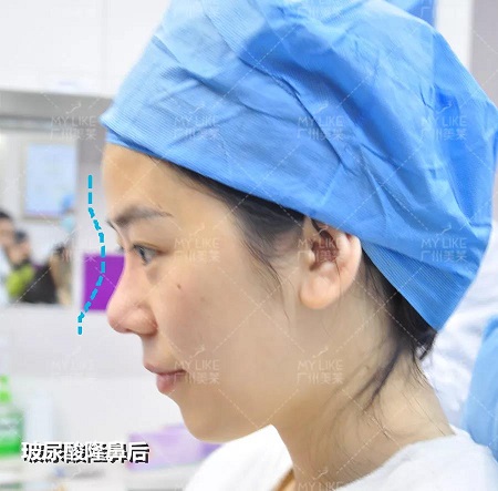 玻尿酸,僅需?80!