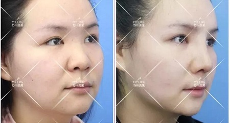 想隆鼻又不想用自己的軟骨,急需一個男票!