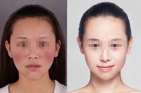 深圳激光去紅血絲多少錢?