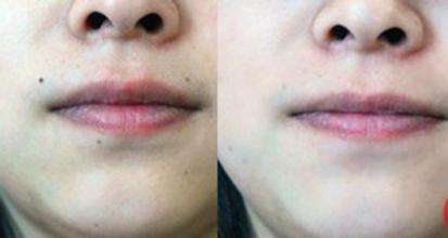 昆明激光點痣的價格多少?