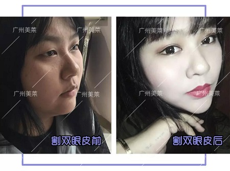 <a href='/ybzx/syp/' target='_blank'><u>割雙眼皮</u></a>后,“眼值”系數(shù)max!睜眼跪!