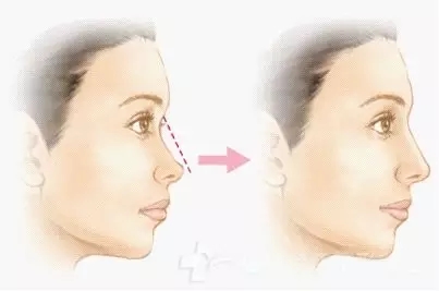 南京假體隆鼻手術一般需要多少錢?