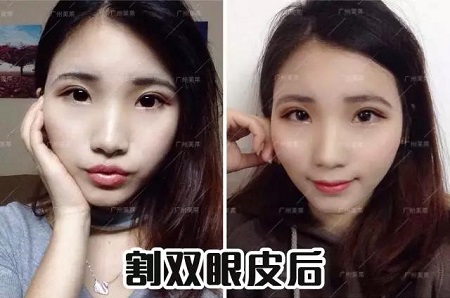 雙眼皮怎樣割，才能美出辨識(shí)度？